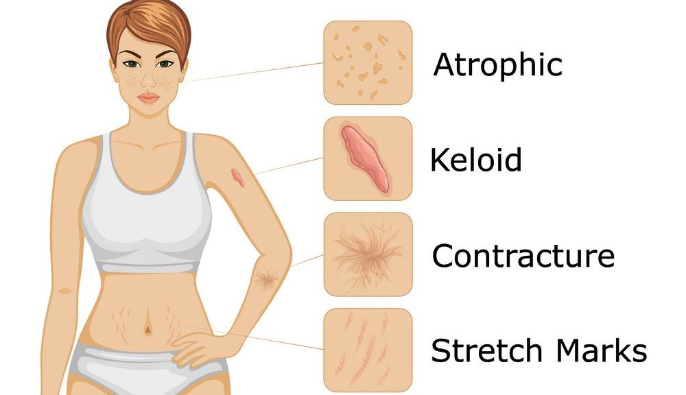 Illustration of SCAR MANAGEMENT