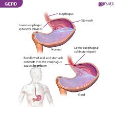 Illustration of GERD ANTACID